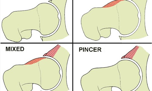 Il Conflitto Femoro Acetabolare (FAI: FEMORO ACETABULAR IMPINGEMENT)